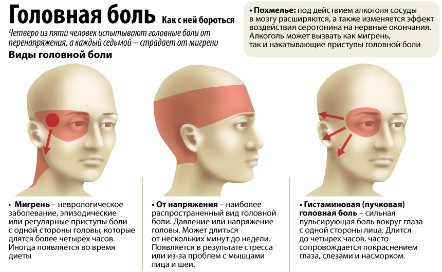 Ли головные боли. Виды головной боли. Головная боль локализация. Боль в голове. Причины головной боли.