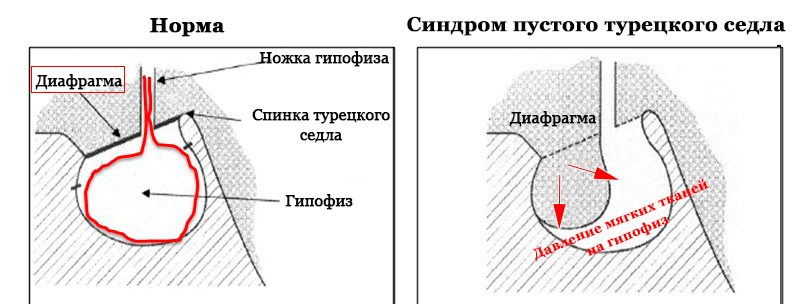 Формирующееся турецкое седло в головном мозге