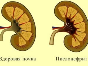 Пиелонефрит хронический