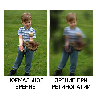 как видят люди с ретинопатии