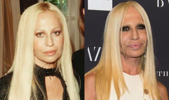 Донателла Версаче до и после пластики. https://garderobus.ru/interesnoe/samye-izvestnye-zhertvy-plasticheskoy-hirurgii.html