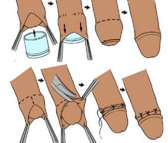Плюсы и минусы обрезания - показания к проведению циркумцизии