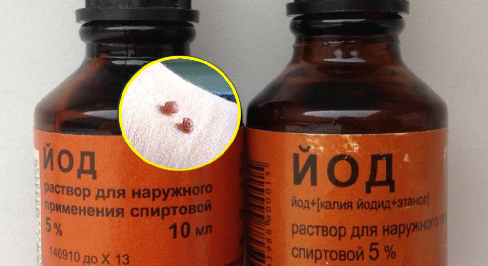 родинка, удаление родинок, родинки на теле, родинки на лице, папилломы, бородавки, удаление папилломы, избавиться от бородавки, папилломы на шее