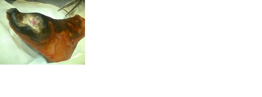 Как видите там все плохо , гангрена, а это значит минус стопа.