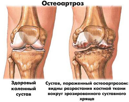 Почему хрустят ноги: причины и советы