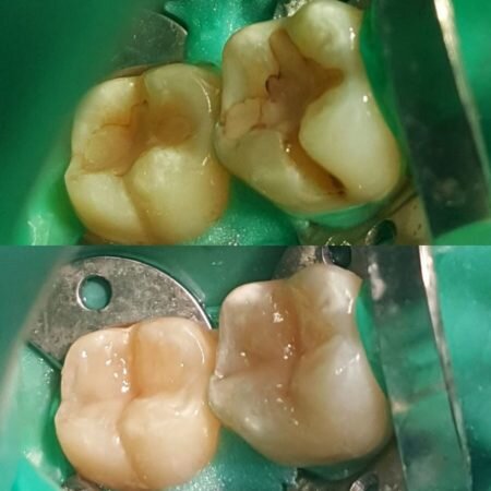 Реставрация зуба пломбировочным материалом светового отверждения