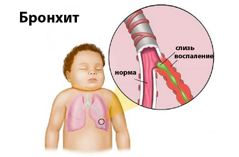 Как лечить бронхит у детей