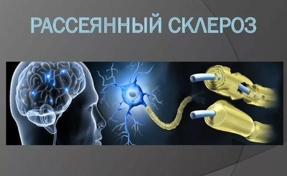 Упрощённая картинка рассеянного склероза. Есть мозг, есть нервы, есть тело: а контакта между ними нет