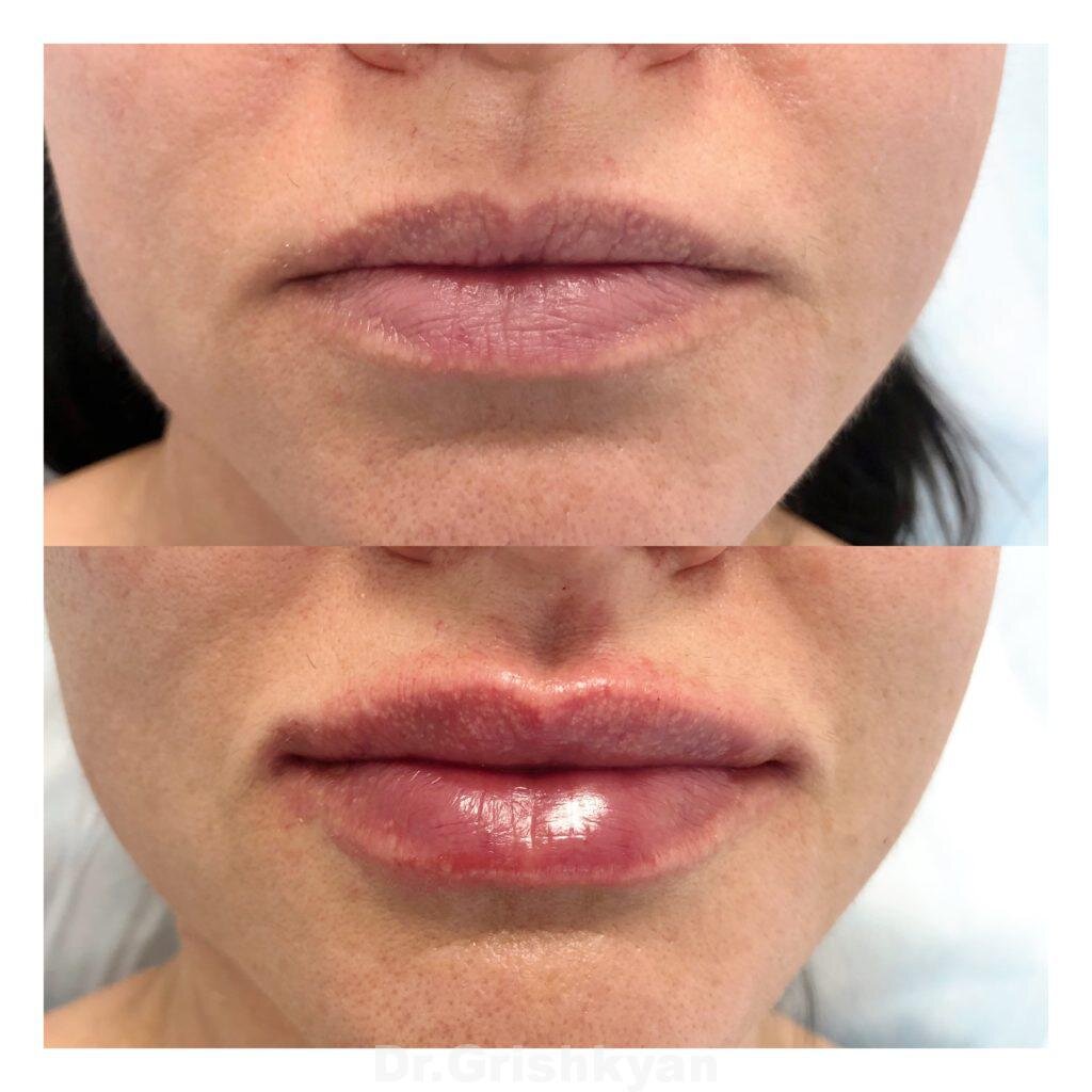 Фото до и после увеличения губ. Фото с сайта Д.Р. Гришкяна. Имеются противопоказания, требуется консультация специалиста