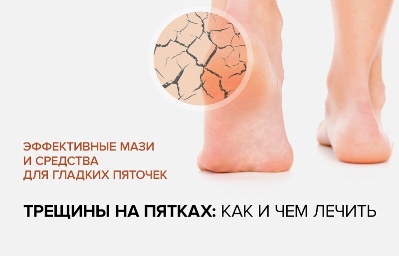 Трещины на пятках - как и чем лечить