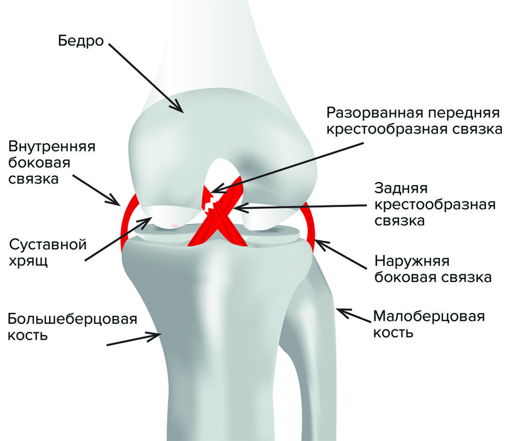 Крестовидная коленная связка