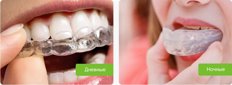 Капы для лечения бруксизма