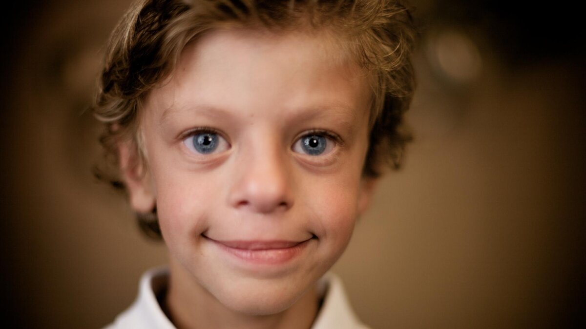 Ребенок с синдромом Вильямса