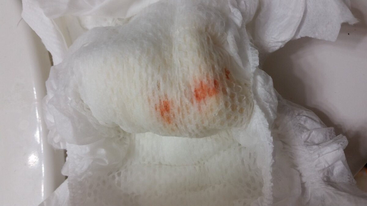 У нас подобные были, только менее заметные. Источник фото https://community.whattoexpect.com/forums/june-2015-babies/topic/thought-baby-had-blood-in-diaper-brick-dust.html