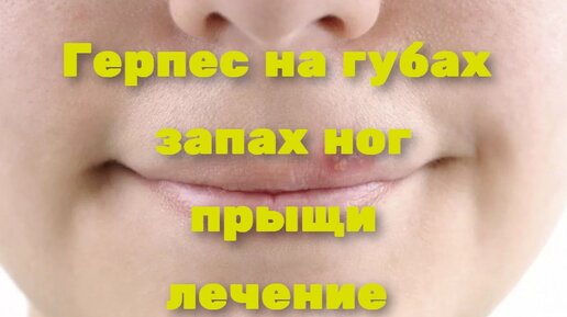 Герпес на губах, запах ног, прыщи лечение