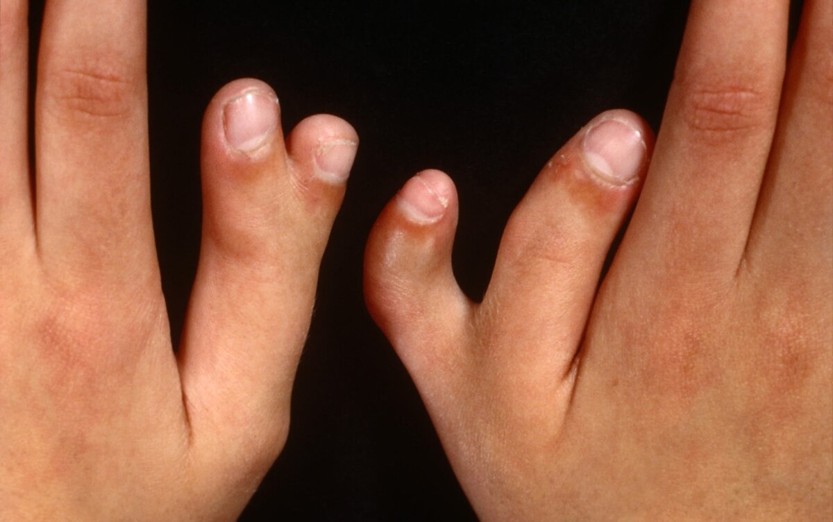 На 1 руке 6 пальцев. Постаксиальная полидактилия кистей. Синдром Паллистера холла. Полидактилия генная мутация. Наследственная синдактилия.