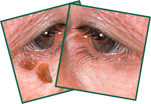 Несколько лет назад у меня незаметно начали появляться папиломы на веках и вокруг глаз. Скоро это превратилось в...