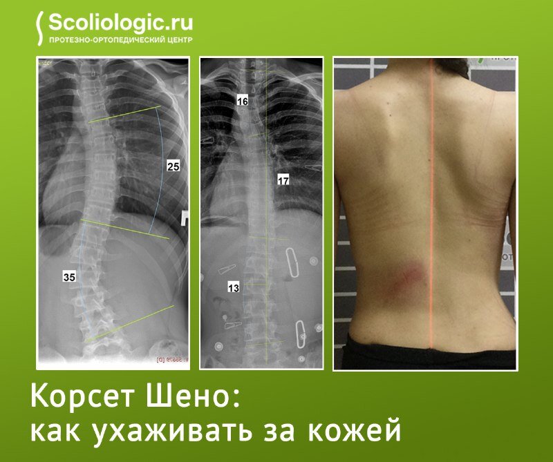 Изготовление корсетов Шено для позвоночника в СПБ, низкие цены