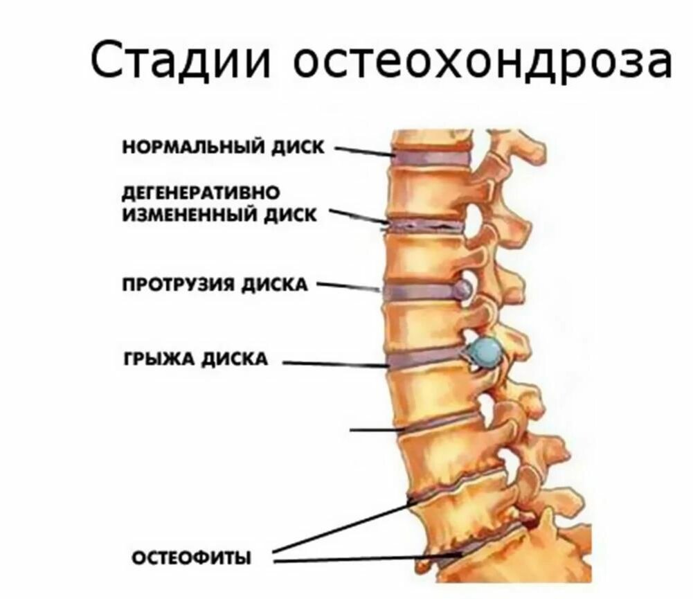 Остеохондроз позвоночника: причины, симптомы, стадии, лечение, профилактика