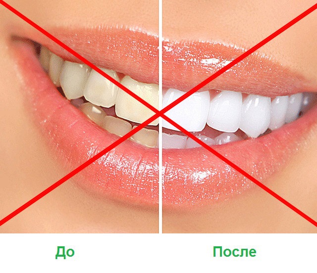 И кстати, эта картинка — вообще фотошоп. До такого ровно белого, «фаянсового» цвета отбелить зубы почти невозможно, в большинстве случаев такого цвета (Bleach1) можно добиться только винирами.