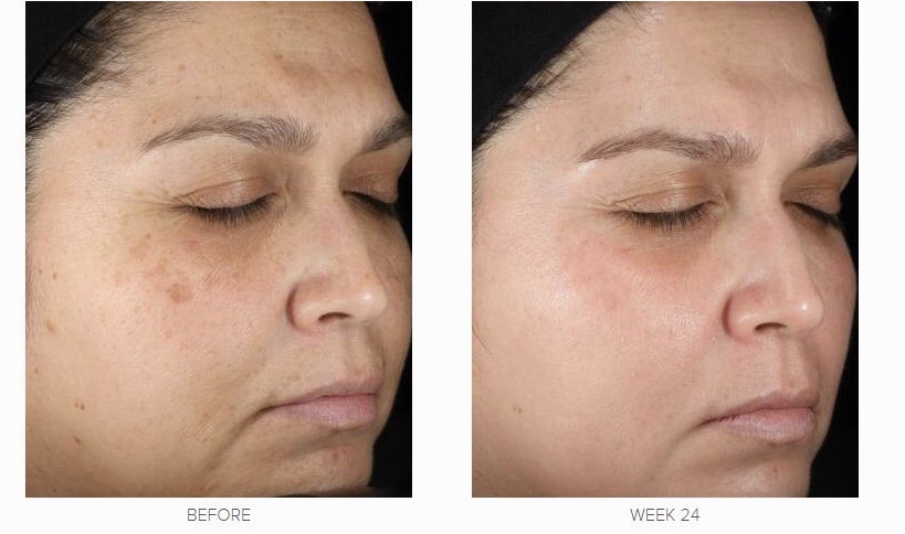 Через 24 недели использования  крема с содержанием 1,0% ретинола 