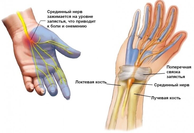 Почему немеют руки во сне?