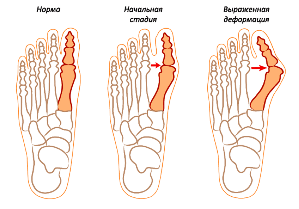 Степени вальгусной деформации 1 пальца стопы