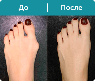 Уродливые выпуклости в основании больших пальцев ног возникают из-за вальгусного искривления стопы. Испробовав средство от вальгуса OrthoFix, вы нейтрализуете первопричину болей, воспалений и отеков, после чего уйдут и внешние проявления. В отличие от корректоров, предлагаемых в аптеках России, новинку удобно применять – ножные ванночки и примочки приносят приятные ощущения, запуская позитивную динамику. С сильным союзником легко можно победить давний недуг, который причинял немало мучений. Да и выбор обуви скоро станет более богатым и уже не будет сводиться к широким и некрасивым моделям. 


Какими свойствами обладает препарат ОртоФикс от вальгуса?
Действие уникальной разработки отличается комплексным характером. Речь идет не только об анестезии – во время курса работа ведется в нескольких направлениях. Вот наиболее важные из них:

Остановка воспалительных процессов.
Удаление солевых отложений.
Снятие болей и спазмов.
Придание суставу и пальцам правильной формы.
Постепенное уменьшение шишки вплоть до полного рассасывания.
Предотвращение осложнений и рецидивов.
Нормализация кровообращения.
Итак, средство от вальгусной деформации стопы OrthoFix не оставит вас один на один с неприятностями. Здоровье ног нуждается в особой заботе, так что не игнорируйте тревожные сигналы и занимайтесь нарушениями на начальной стадии. И тогда в ближайшем будущем вы обретете по-настоящему легкую походку, которая, казалось бы, была совсем утрачена.

Почитать подробнее вы можете на официальном сайте товара