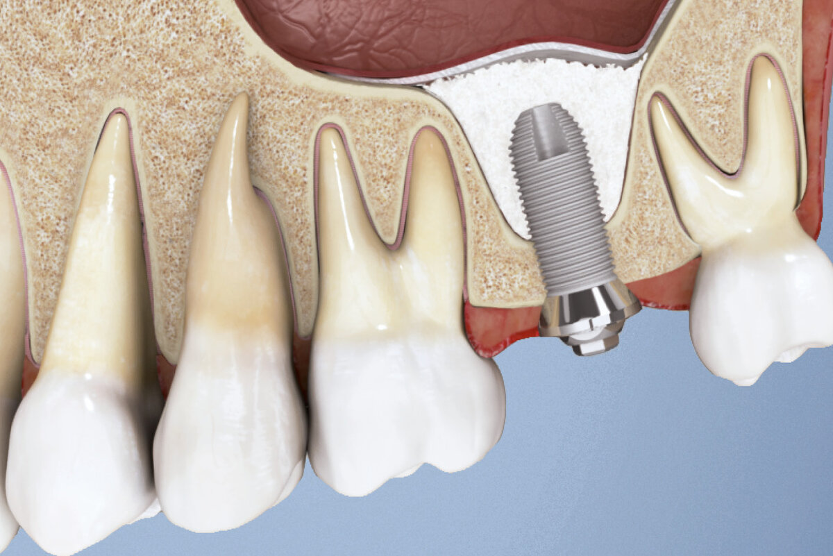 Атрофия костной ткани челюсти - способы лечения и восстановления зубов ...