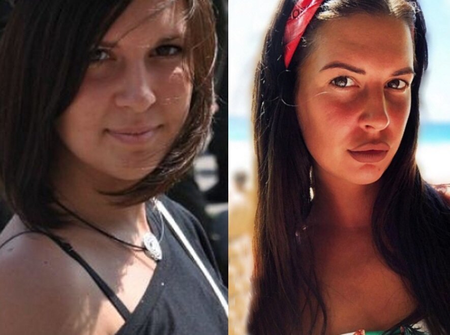 Донцова до и после пластики