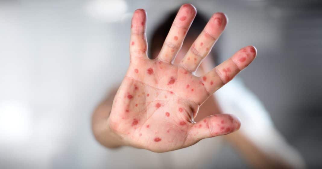 Корь может быть причиной появления преддиабета у детей