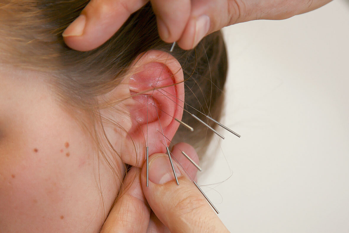 Аурикулотерапия (акупунктура уха). Часто применяется в лечении от курения, при нервных стрессах, а также для похудения.