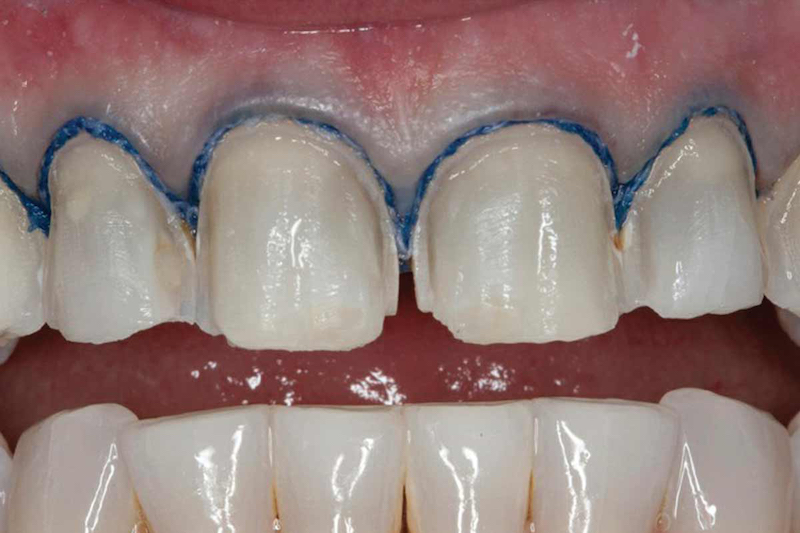 Зубная нить: плюсы и минусы