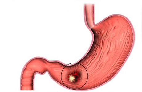 Рак желудка