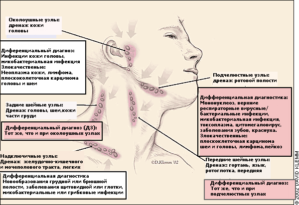 Шейный лимфаденит: симптомы, лечение, диагностика