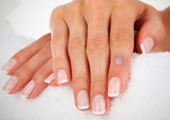 как избавиться от бородавок народными средствами