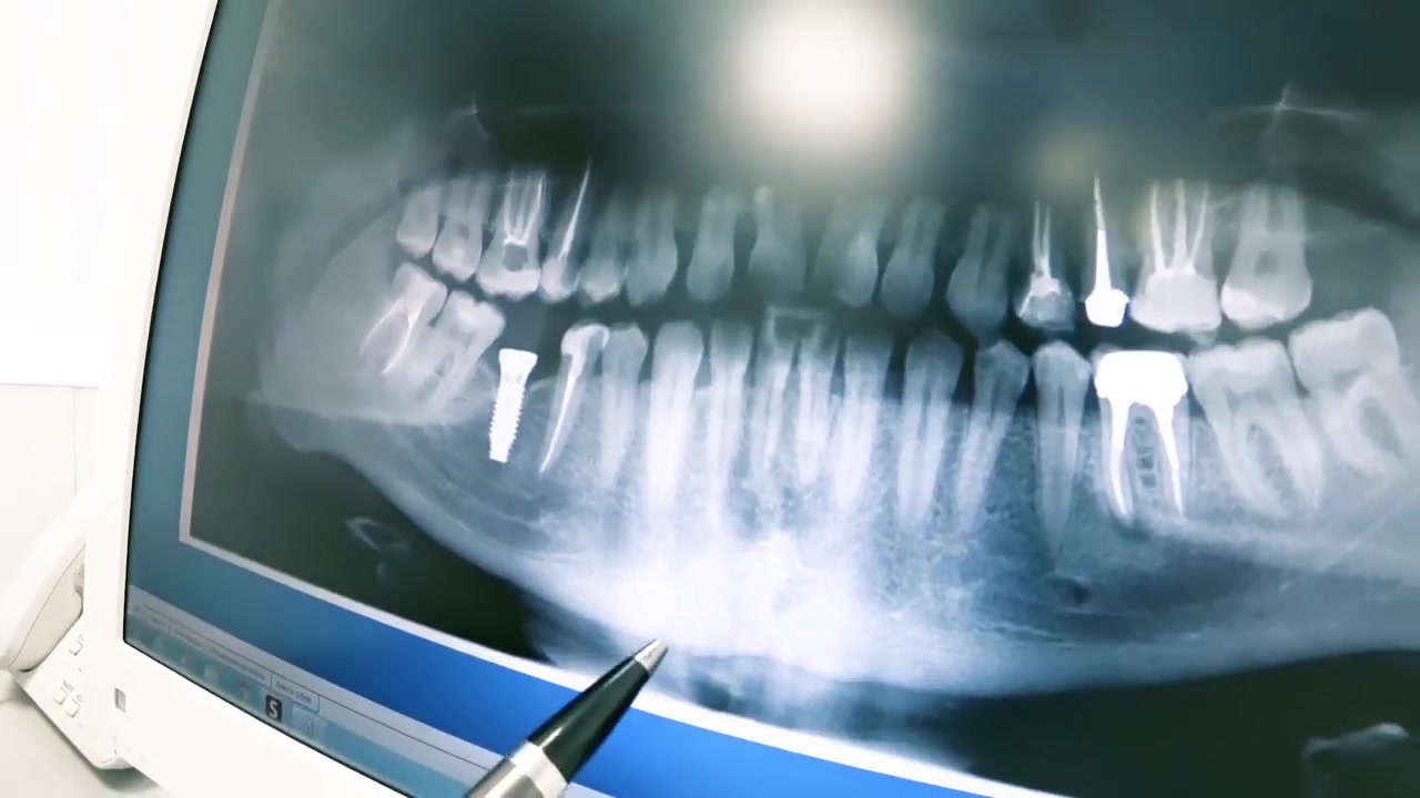 Как расшифровать рентген зуба? | Блог Мед-Део