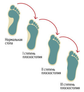 С плоскостопием от армии не откосить: Госдума пересмотрит требования к призывникам