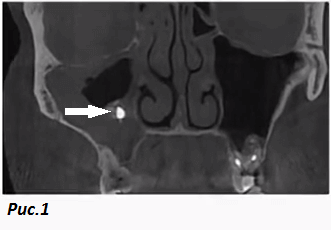 Инородное тело в правой гайморовой пазухе интенсивно контрастирует на компьютерной томографии, указано стрелкой. Вокруг него менее интенсивная обширная тень, указывает на утолщение слизистой пазухи. Кстати на другой стороне видно как корни зубов могут сообщаться с полостью пазухи. Фото для примера из Интернета.