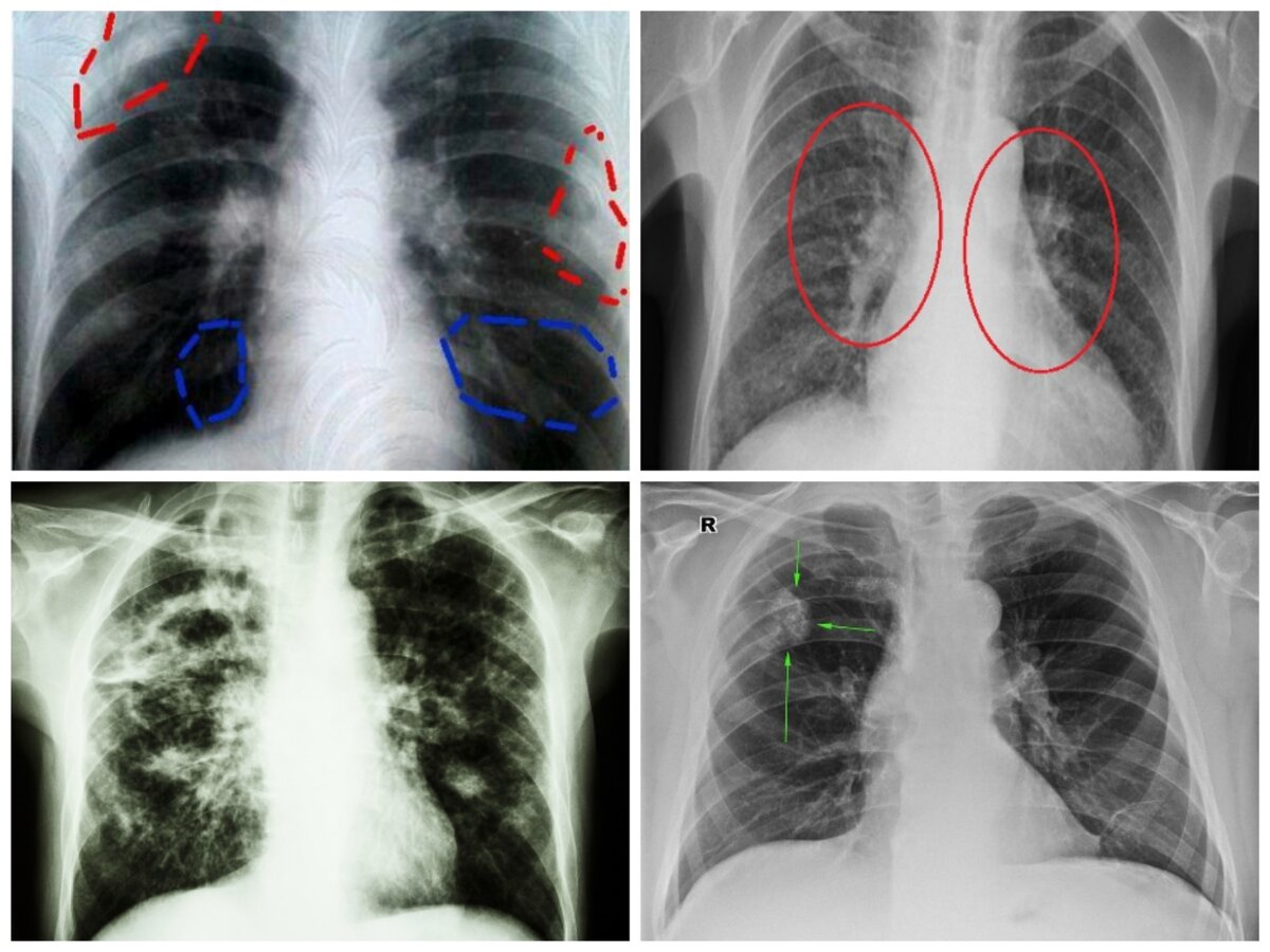 Флюорограмма при туберкулезе легких