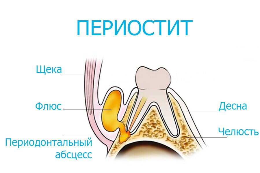 Периостит