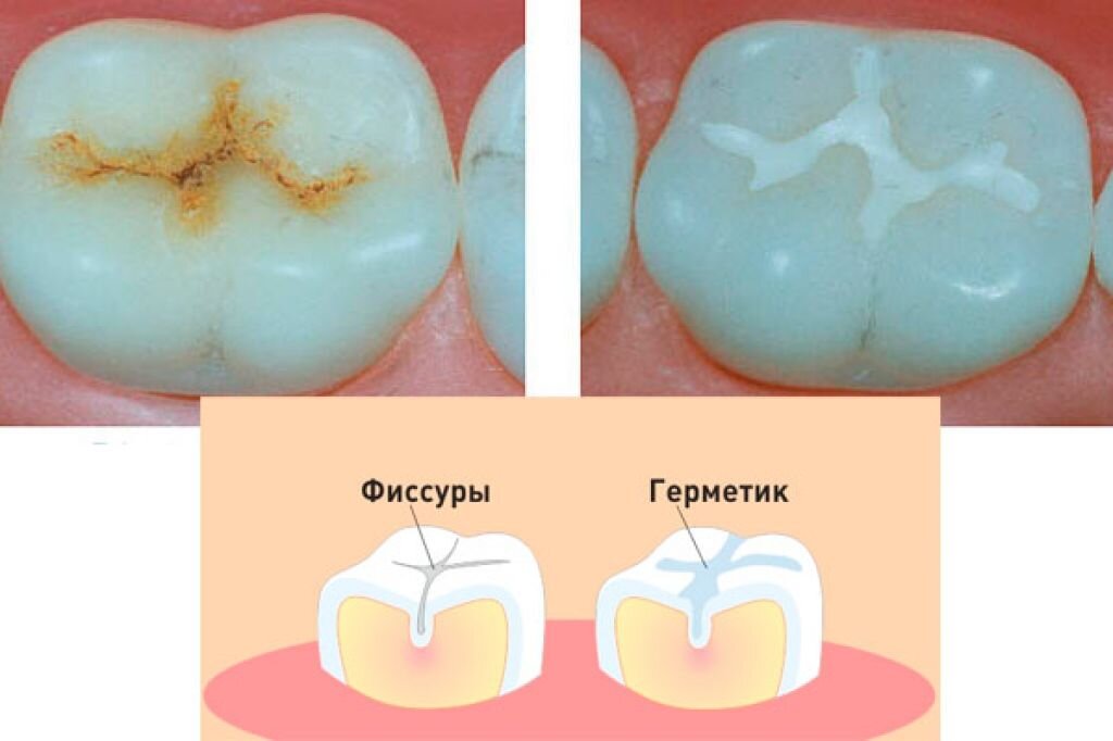Герметизация фиссур картинки