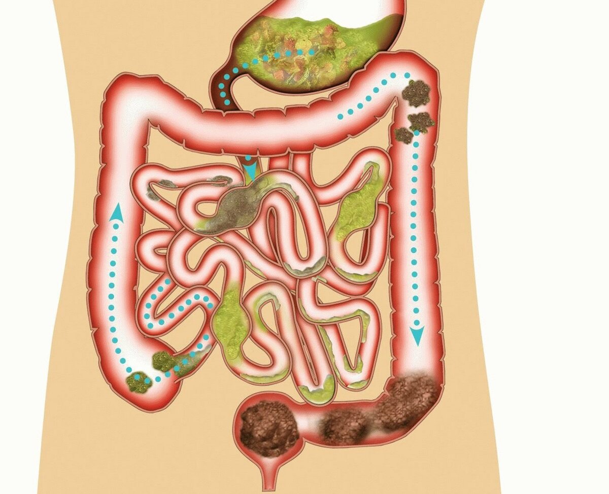 Ленивый кишечник самостоятельно без слабительного. Загрязненный кишечник.