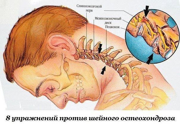 Первые проявления шейного остеохондроза — боли в спине, головные боли, головокружение, "мушки" в глазах, ухудшение слуха или шумы, а также покачивание при ходьбе в результате нарушения координации. Чтобы этого не случилось, предлагаем нехитрые упражнения, которые помогут вам победить остеохондроз и сберечь здоровье.
1. Подбородок опустите к шее. Поверните голову сначала 5 раз вправо, а затем 5 раз влево.
2. Чуть-чуть приподнимите подбородок. Опять поверните голову вправо 5 раз, потом влево 5 раз.
3. Наклоните голову вправо, пытаясь достать ухом плечо — 5 раз, затем влево 5 раз.
4. Голова прямо. Преодолевая сопротивление напряженных мышц шеи, прижать подбородок к яремной ямке. Макушка головы при этом тянется вверх.
5. Надавите лбом на ладонь и напрягите мышцы шеи. Упражнение выполните 3 раза по 7 секунд..
6. Напрягая мышцы шеи, надавите левым виском на левую ладонь (3 раза по 7 секунд). А теперь правым виском надавите на правую ладонь (3 раза по 7 секунд).
7. Подбородок прямо, руки на затылок. Надавить затылком на руки 3 раза по 7 секунд.
8. Руки, соединенные в пальцах, подвести под подбородок. Надавить подбородком на руки 3 раза по 7 секунд.