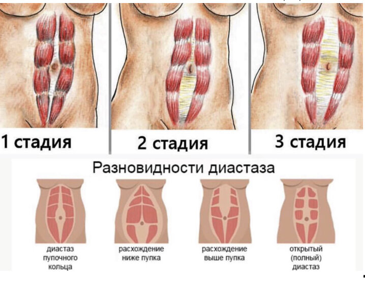 Диастаз (стадии)