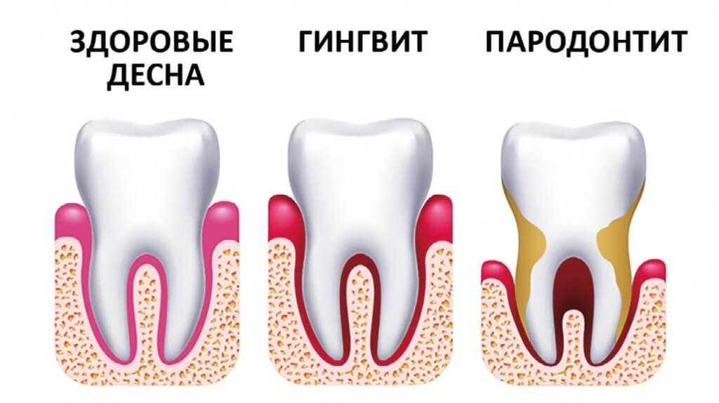 что происходит при пародонтите. фото из свободных источников 