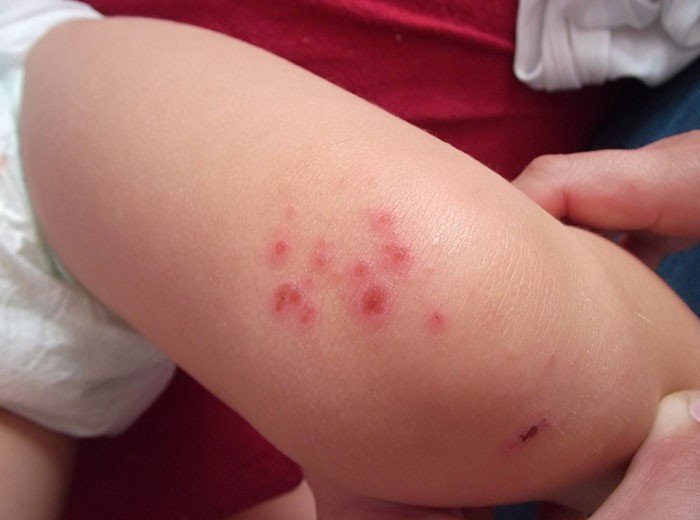 Пищевая аллергия у детей до года