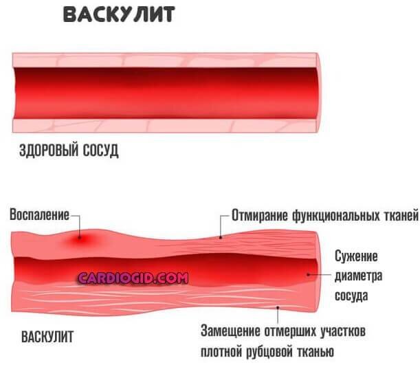 Симптомы буллезной эмфиземы