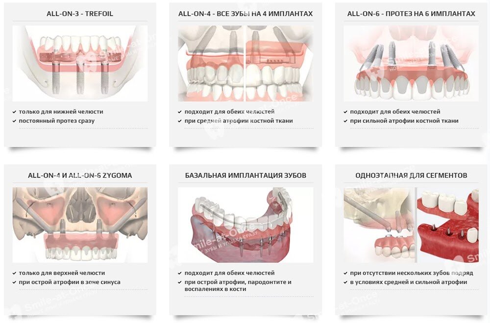 Все об имплантации зубов подробно в деталях с наглядными картинками