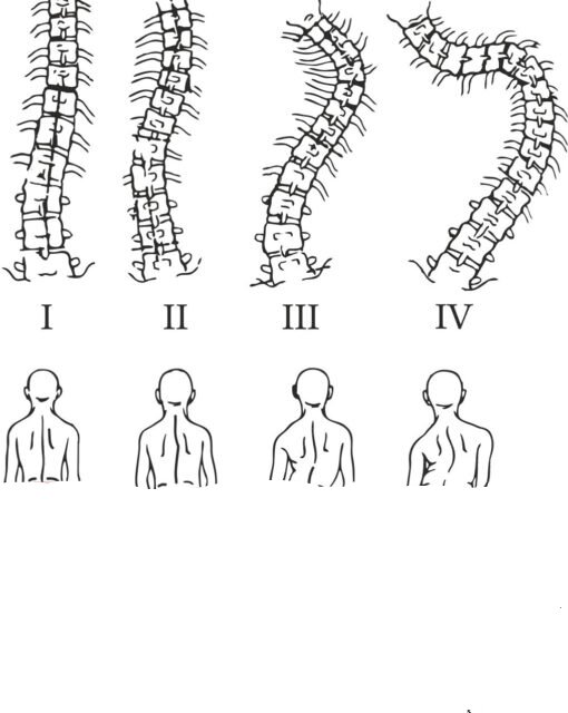 Степени скривления позвоночника